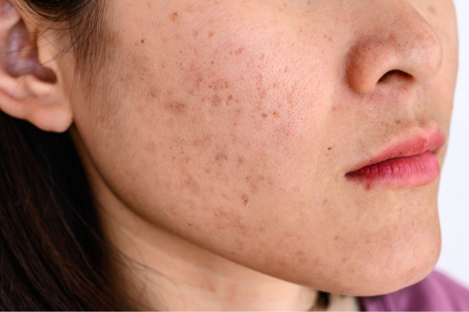 Woman's cheek with Melasma.