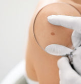 dermatologist checking a mole