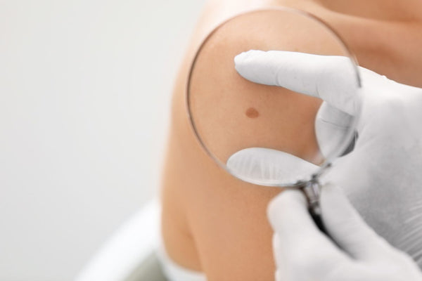 dermatologist checking a mole