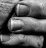 Melanoma Under Your Fingernails