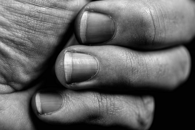 Melanoma Under Your Fingernails