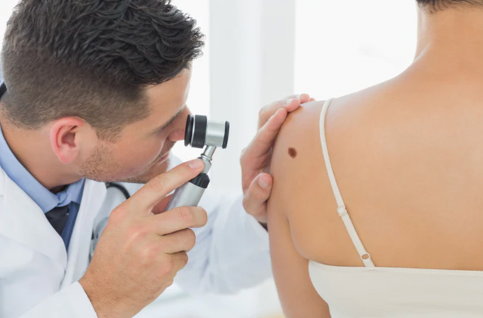 dermatologist looking at a mole