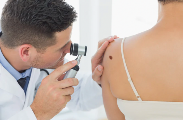 dermatologist looking at a mole