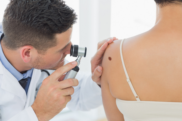 dermatologist examining a woman's mole for Melanoma