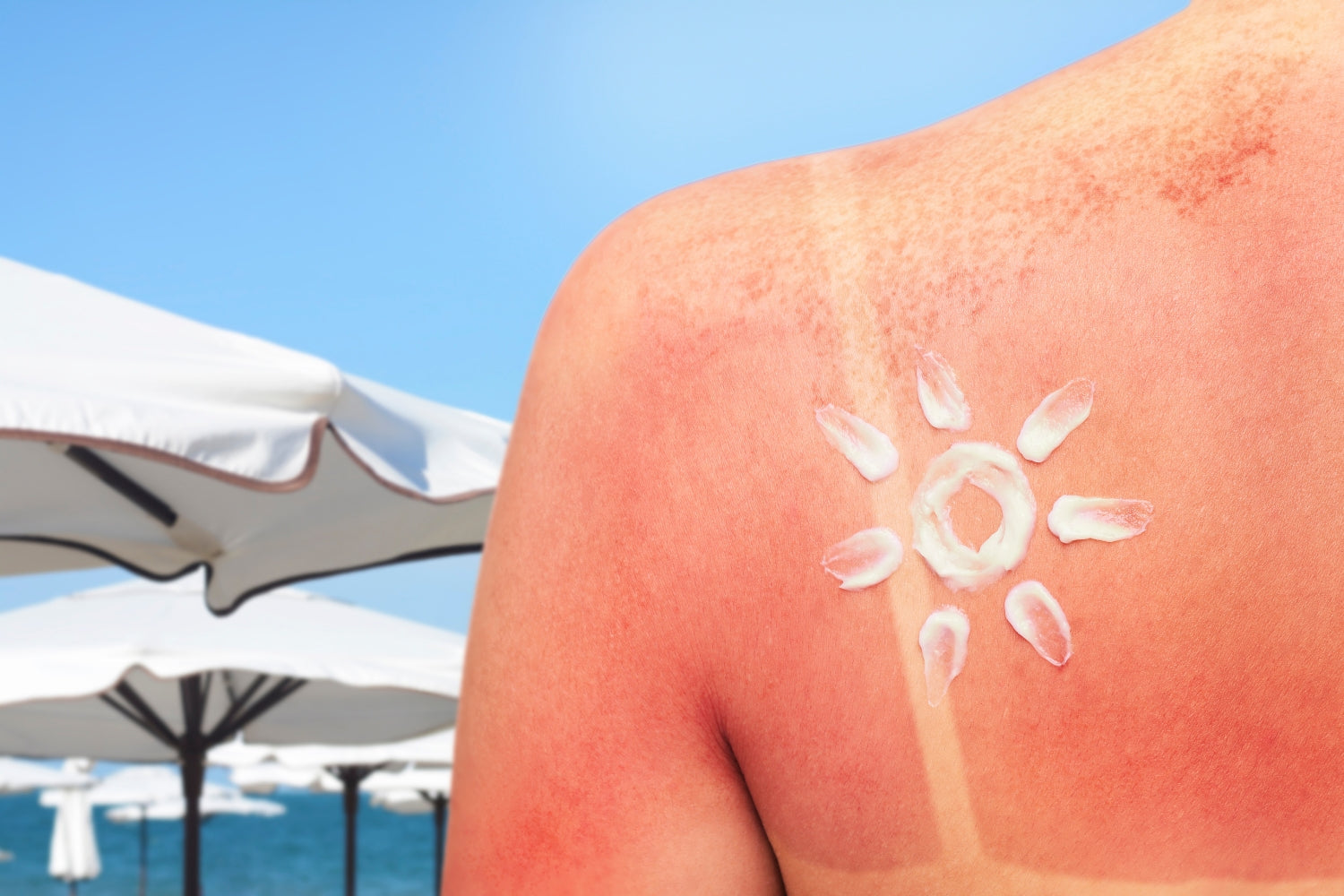 Don't Fry Day: What It Is and How to Stay Sun-Safe This Summer