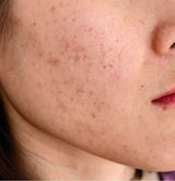 Woman's cheek with Melasma. 