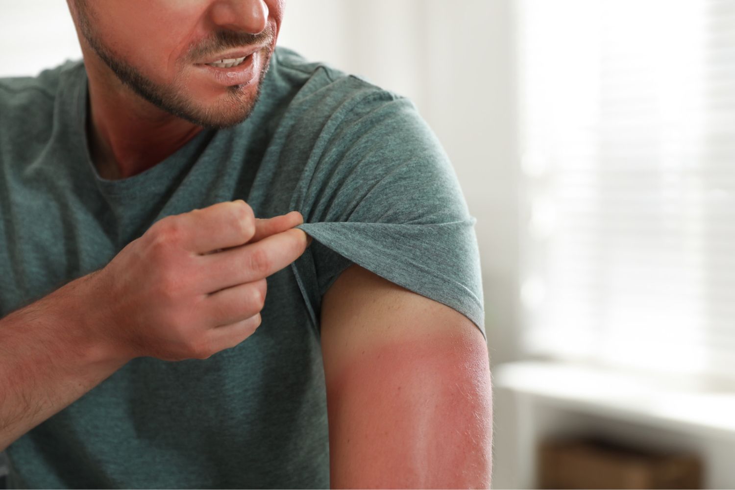 Man with a sunburn