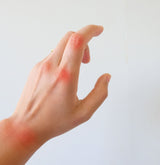 Hand with rheumatoid arthritis after being exposed to the sun
