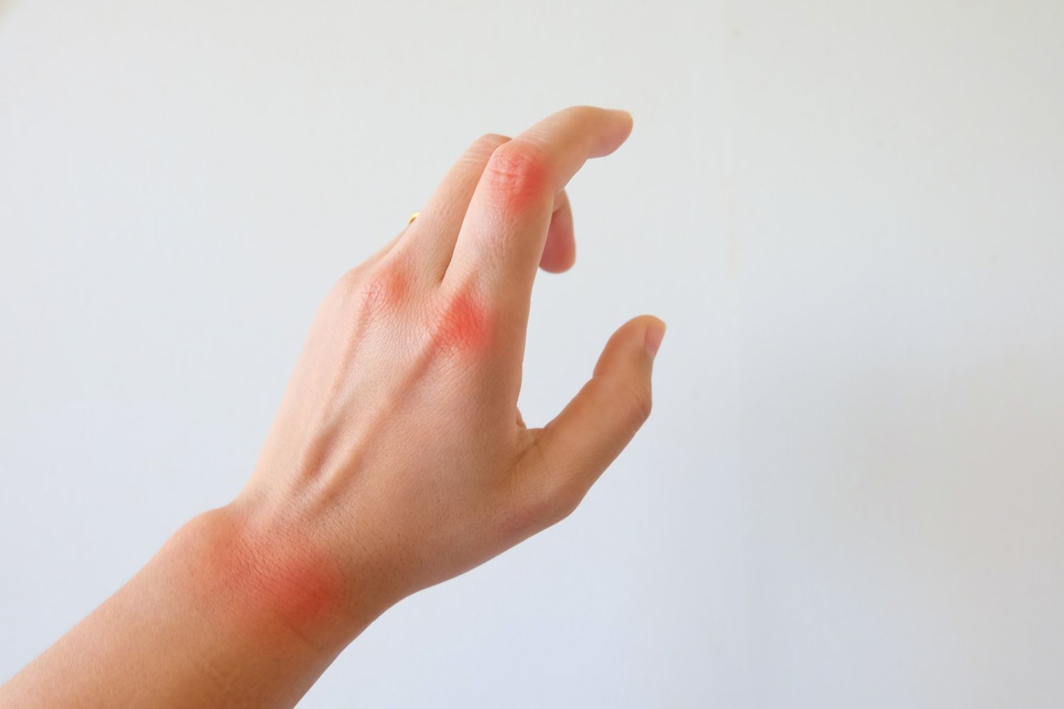 Hand with rheumatoid arthritis after being exposed to the sun